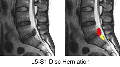 Radiculopathy — Matthew Mian, MD