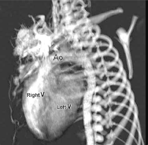 Complete Transposition Of The Great Arteries On Three Dimensional