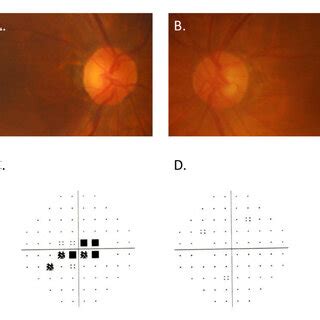 A B Color Fundus Photographs Of The Right Eye A And Left Eye B