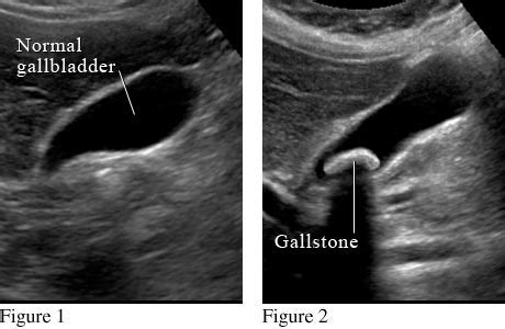 Gallstones Information Treatment