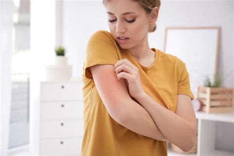 The Most Effective Ways To Get Rid Of Hives