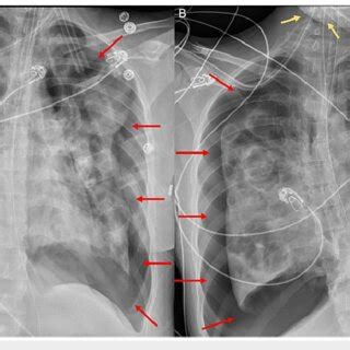 Portable Semi Erect Anterioposterior Radiographs Of The Chest A B