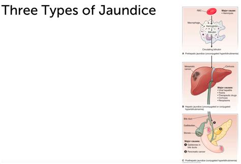 Jaundice Diagram