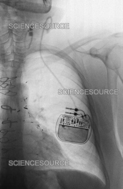 Vagus Nerve Stimulator Epilepsy X Ra Stock Image Science Source