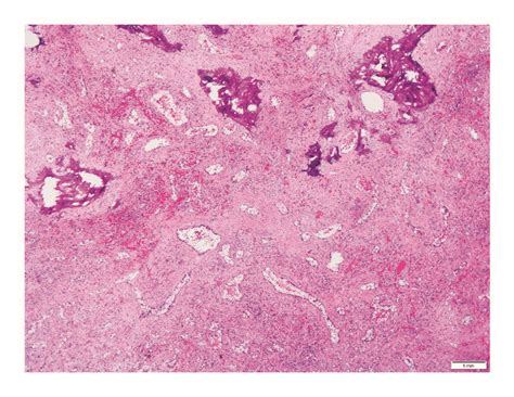 Photomicrographs Of Hepatic Epithelioid Hemangioendothelioma A This