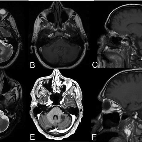 N Both Cases Brain Mr Imaging Revealed Well Defined T2 Hyperintense