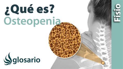 Osteopenia Qué Es Qué Afecta Síntomas Signos Clínicos Causas Y Tratamiento