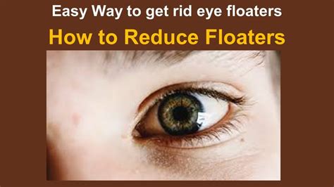 How To Reduce Floaters Easy Way To Get Rid Eye Floaters YouTube