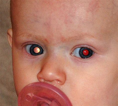 Signs And Symptoms Of Retinoblastoma We C Hope