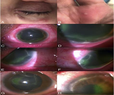 Adjuvant Topical Interferon Alpha 2b For The Treatment Of Mo Cornea