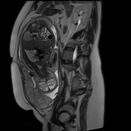 Placenta Accreta Image Radiopaedia Org