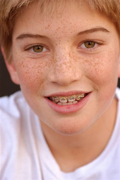 Braces With Smile Royalty Free Stock Photos - Image: 9134338