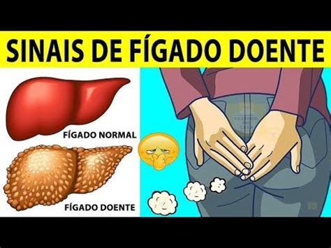 Sinais De F Gado Doente Youtube Em Gordura No Figado