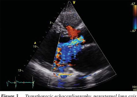 Figure 1 From Aortic Regurgitation Due To Quadricuspid Aortic Valve