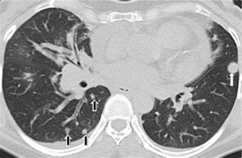 Lesiones Pulmonares Relacionadas Con El Tabaquismo Hallazgos Y