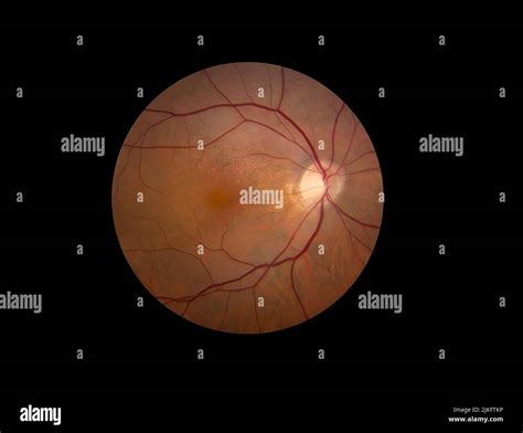 A New Clinical Study Led By The National Eye Institute Nei Part Of