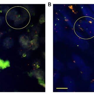 Representative Images Of Ntrk Fusion Detected By Fish Tumor Tissues