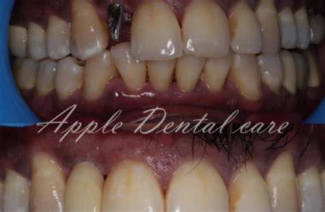 Dental Implant In Ramanathapuram Apple Dental Care