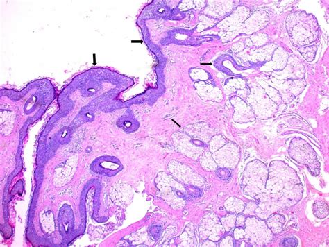 Dermoid Cyst Oral