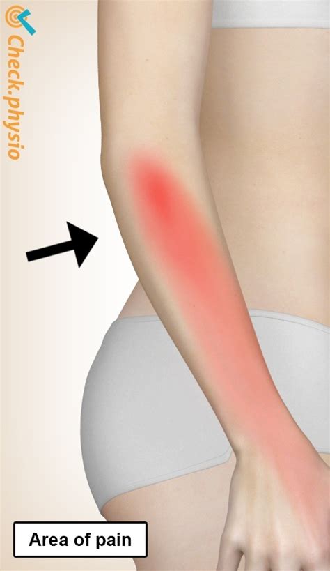 Radial Tunnel Syndrome Physio Check