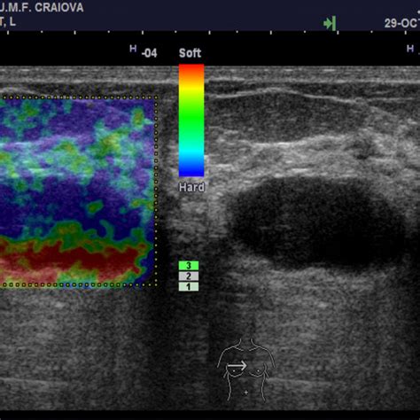 Diffuse Optical Tomography Prototype Philips Healthcare Best The