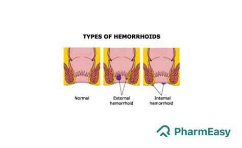 Internal Hemorrhoids Banding