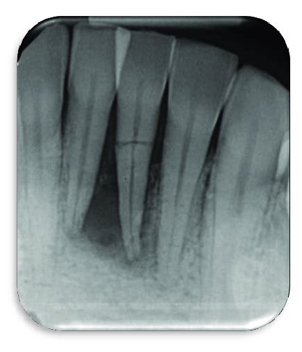 This Radiograph Shows Tooth24 Horizontal Fracture And Radiolucency In