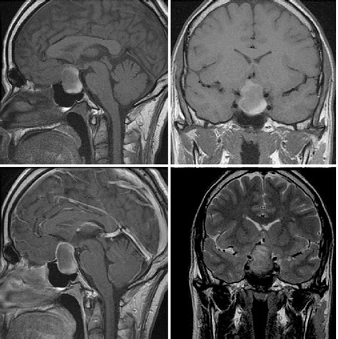 Magnetic Resonance Imaging Scan Showing A Cystic Sellar And Suprasellar