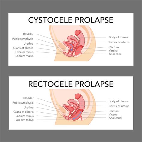 Pelvic Floor Prolapse Surgery Recovery Review Home Co