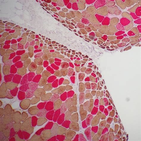 Dermatomyositis Histology