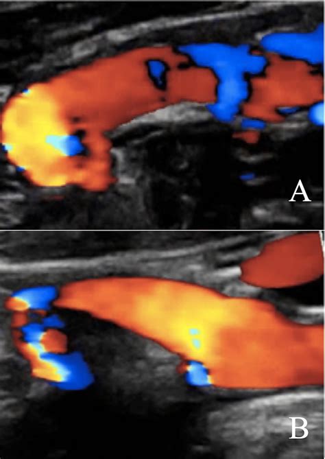 Duplex Ultrasound Of The Left Distal Internal Carotid Artery