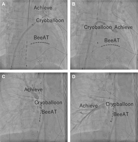 Pulmonary Vein Angiography During Cryoballoon Ablation Anteroposterior Download Scientific