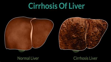 What Is Cirrhosis Symptoms And Causes