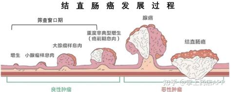 结直肠癌治疗需要做哪些基因检测，有哪些靶向药可选？可以医保报销吗？ 知乎