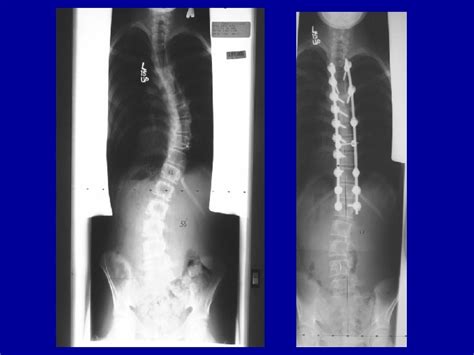 Scoliosis A Nursing Overview Ann S Goodson R