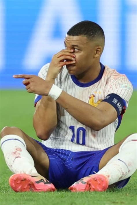 Euro 2024 naso rotto ma niente operazione per Mbappé quando tornerà