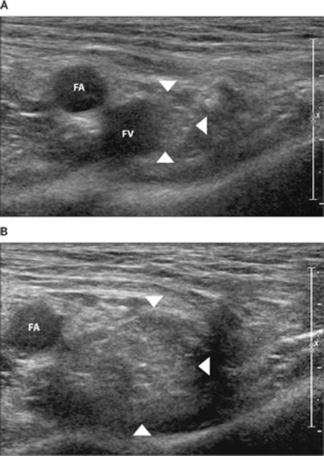 Indirect Inguinal Hernia Ultrasound