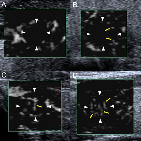 Figure 1 From Diagnostic Performance Of ACR TIRADS Combined With Superb