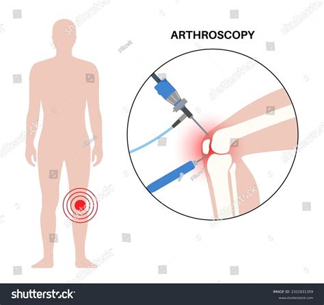 Cruciate Ligament Cut: Over 3 Royalty-Free Licensable Stock Vectors ...