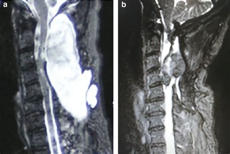 The First Case A Pre Operative Area Of The Pseudomeningocele On