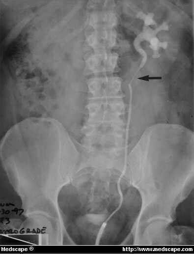 Stenosis Stenosis Ureter