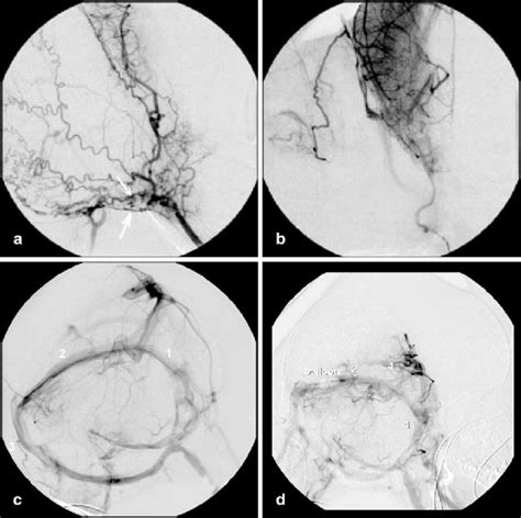 A Digital Subtraction Angiography Dsa With Contrast Injection In The Download Scientific