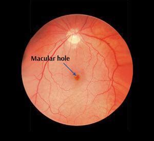 Macular Hole St. Leonards | Vitrectomy Surgery | Vision Problems North Shore