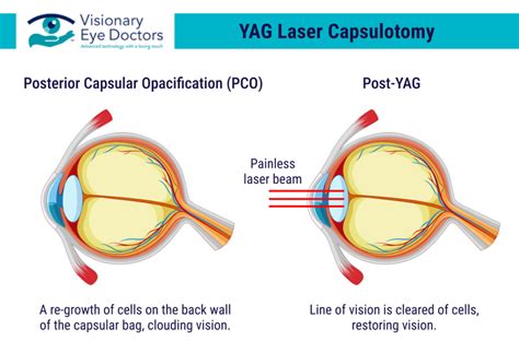 Understanding YAG Laser Capsulotomy Clarity After Cataract Surgery