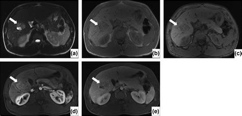 Hepatocellular Adenoma Imaging Review Of The Various Molecular