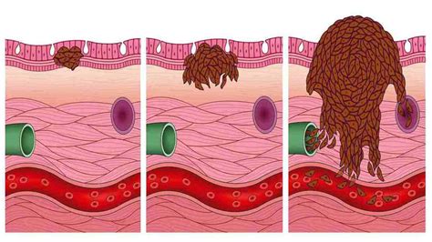 Skin Cancer Types List