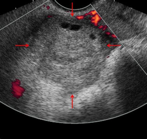 Ovarian Torsion Ultrasound Doppler