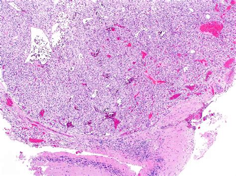 Hemangioblastoma Foamy Cells