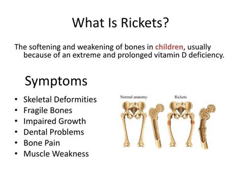 PPT - Rickets Disease PowerPoint Presentation - ID:2568458