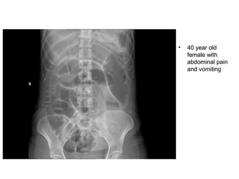 Introduction To Abdominal X Ray Interpretation Ppt